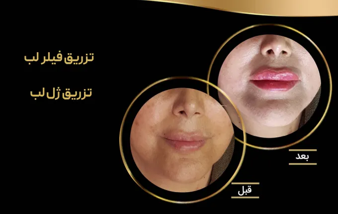 تزریق فیلر لب