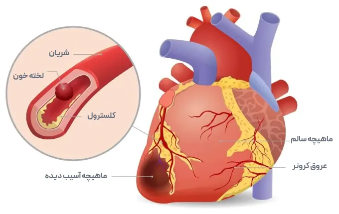 قلب درد و علائم سکته قلبی