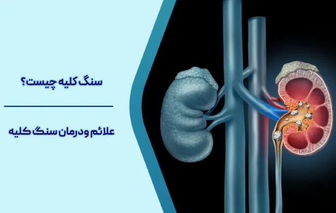 علت سنگ کلیه