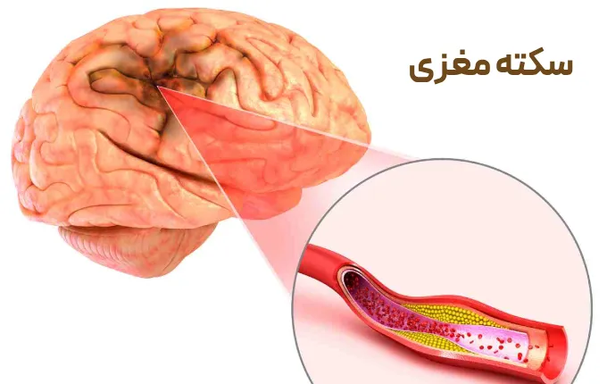 دلایل سکته مغزی و علائم سکته مغزی